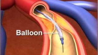 Percutaneous coronary Intervention stenting [upl. by Dorcus]