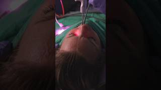 What happens during a balloon sinuplasty balloonsinuplasty nasalcongestion entcare [upl. by Seugram818]