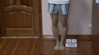 Bow legs genu varum correction treatment in Ukraine  USA patient experience [upl. by Montano]