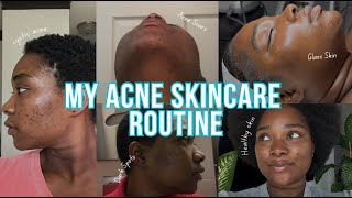 My Cystic Acne Skin Care Routine  How to treat acne on face  Skincare tips for clear skin [upl. by Alodi]