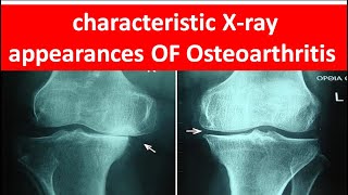 How to diagnose Osteoarthritis by xray [upl. by Corina]