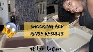 ACV RINSE RESULTS on my LOCS I WAS SHOCKED [upl. by Aizek]