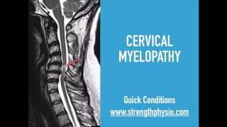 Cervical Spine Myelopathy [upl. by Camroc]