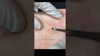 Botfly Maggot Removal [upl. by Weeks412]