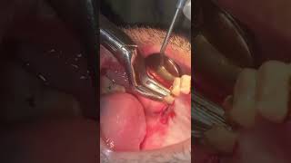 Extraction of upper right second molar roots [upl. by Domph]