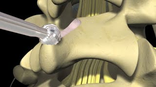 Low Back Pain Lumbar Laminectomy Surgery [upl. by Lorrac657]