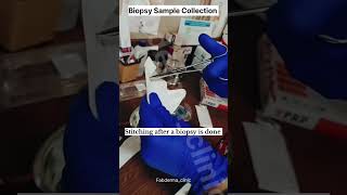 Biopsy Sample Collectionfabdermaclinic drdivitabhuraria dermatologist [upl. by Laniger613]