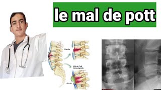 le mal de pott ou spondylodiscite tuberculeuse [upl. by Cogen372]