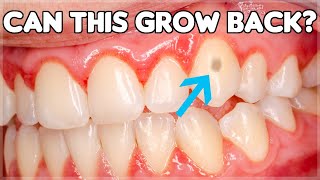 Can Tooth Enamel Grow Back How To Prevent Enamel Erosion [upl. by Vinnie]