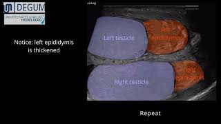 Episode 42 Epididymitis [upl. by Lunetta299]