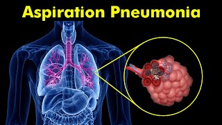 Breathing Trouble Understanding Aspiration Pneumonia [upl. by Assetak691]