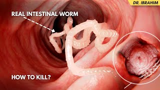 Pait Ke Keeron Ka Ilaj  Remove Intestinal Worms  Pinworms Tapeworms Hookworms  UrduHindi [upl. by Royal445]