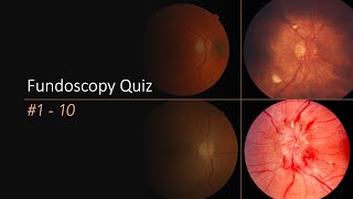 Fundoscopy Quiz [upl. by Iliak]