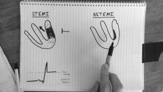 STsegment changes in STEMI amp NSTEMI explained [upl. by Adlanor954]