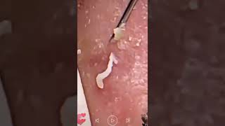 Skincare  Blackheads Removal 217 squeeze squeeze blackheads blackheads [upl. by Aitsirt]