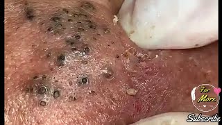 Dr Pop  Deep Blackheads in old Skin removing amp treatment 2020 Part 6 [upl. by Miun]