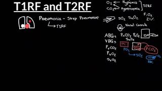 Type 1 and Type 2 Respiratory Failure Part 1 [upl. by Atteuqahc]