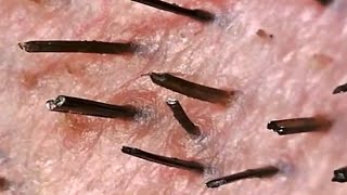 Plucking Hair Under the Microscope Worlds Greatest Medical [upl. by Nylad9]