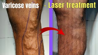 Combination treatment of varicose veins  Laser  Foam Sclerotherapy Laser treatment of varicose [upl. by Tamara]