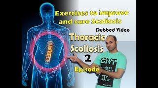 Thoracic scoliosis treatment Episode 2 [upl. by Nevar]