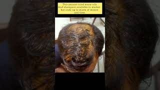 Androgenic alopecia can be reversed alopeciahairtransformationshortshairlosstipsdermatologist [upl. by Ilahtan]