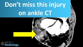 Peroneal tendon injury on CT [upl. by Iadrahs357]