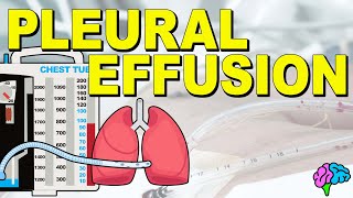 What is a Pleural Effusion EXPLAINED [upl. by Anirdua]