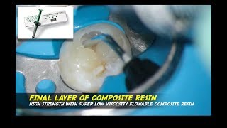 class I cavity with estelite universal flow super low palfique bulkflow endodontist jakarta [upl. by Waxler]