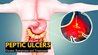 Peptic Ulcers Causes Signs and Symptoms Diagnosis and Treatment [upl. by Martsen]