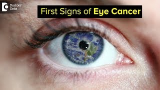 What are the first signs of eye cancer  Dr Sunita Rana Agarwal [upl. by Eladnwahs631]