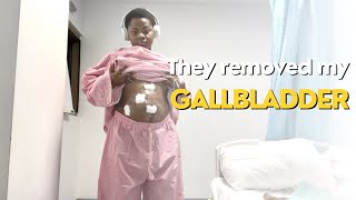 MY LAPAROSCOPIC GALLBLADDER REMOVAL SURGERY  RECOVERY [upl. by Ogawa]