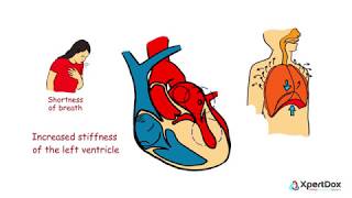 Hypertrophic cardiomyopathy  When the heart muscle becomes abnormally thick [upl. by Esiuole]