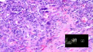 DERMPATH LIVE  January 2016 Clay J Cockerell MD [upl. by Grosvenor]