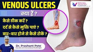 Venous Ulcers के लिए रामबाण इलाज Dr Prashant Pote द्वारा सलाह [upl. by Eisak266]