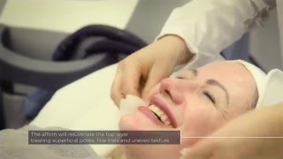 Laser Skin Rejuvenation with Cynosure’s Multiplex Affirm System at The Laser and Skin Clinic [upl. by Uwkuhceki]