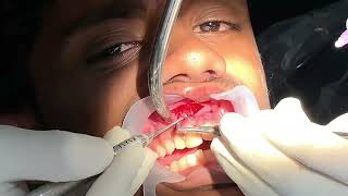 Maxillary tooth apicectomy  curettage and retrograde obturation [upl. by Allana352]