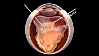 Retinal Detachment  Signs Symptoms and Treatment [upl. by Sirovaj]