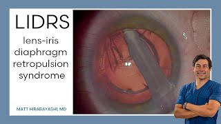 LIDRS lensiris diaphragm retropulsion syndrome Explanation and Demonstration [upl. by Ecirtahs84]