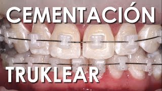 CEMENTACIÓN BRACKETS DE AUTOLIGADO CERÁMICOS  Ventajas y Desventajas [upl. by Annoirb]