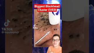 BIGGEST BLACKHEADS REMOVAL EVER  Extreme Blackheads on Cheek shorts [upl. by Polk]