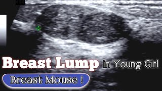 Ultrasound Young Girl Breast  Fibroadenomas  Breast Mouse [upl. by Danice]