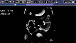 How to read an MR Enterography [upl. by Valoniah]