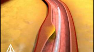 Arterial Stenting  3D Medical Animation [upl. by Annaynek]