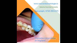 Coroana zirconiu insurubata in implant [upl. by Eillas]