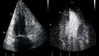 CONTRAST ECHO CARDIOMYOPATHIE TRABECULATION OU NON [upl. by Martelli116]