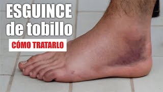 ESGUINCE o TORCEDURA de TOBILLO 🦶🏼 Tratamiento De Rotura De LIGAMENTOS De Tobillo ⭐ Dr EDSON SERRANO [upl. by Nivrad]