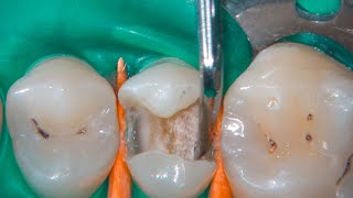 DRendo  Nonselective caries excavation the only correct clinical approach [upl. by Anomor]