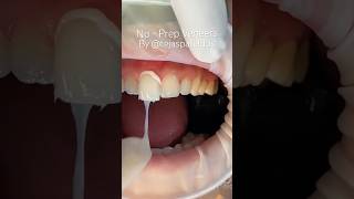 No prep veneers by cosmetic dentist Dr Tejas Patel austinveneers smilemakeover [upl. by Akemhs]