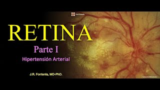 Retina Parte I Hipertensión Arterial Retinopatía Hipertensiva [upl. by Vernon]