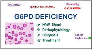 G6PD Deficiency  PathophysiologyClinical FeaturesLab DiagnosisTreatment pathology biochemistry [upl. by Eirak]